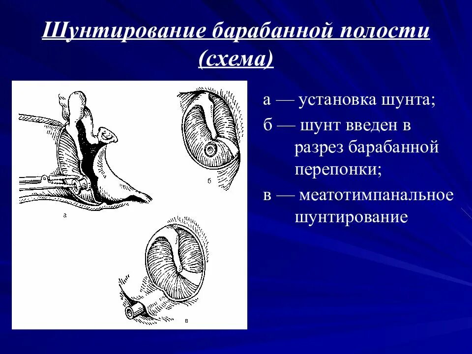 Шунт барабанной полости. Титановый шунт. Титановый шунт. Шунтирование барабанной перепонки. Коронарная ангиопластика и стентирование.