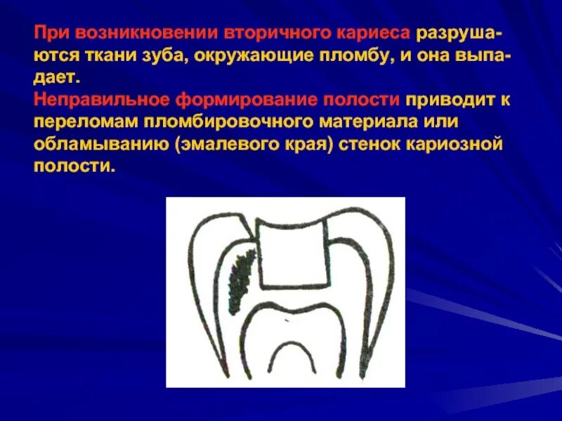 Ошибки при препарировании кариозных полостей. Ошибки при препарировании кариозных полостей