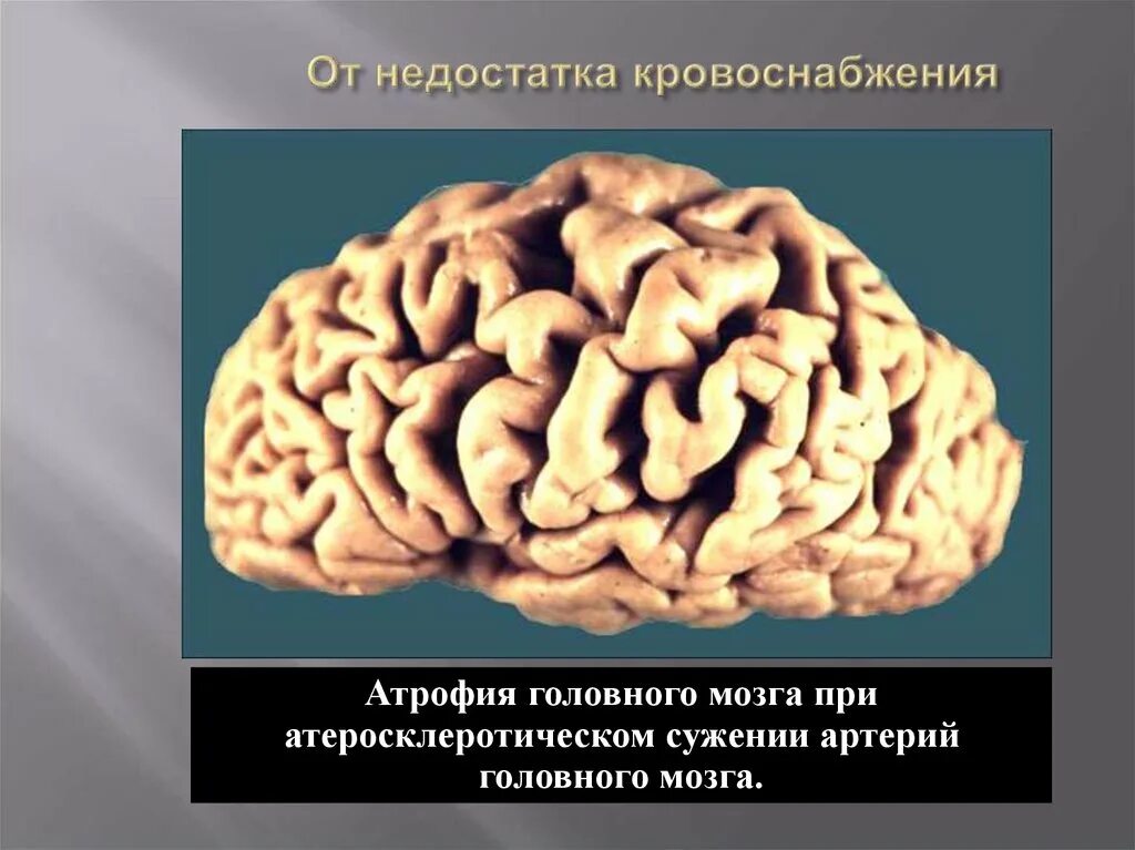 Атрофия мозга лечение. Атрофия от недостатка кровоснабжения. Недостаток кровоснабжения головного мозга. Атрофия вызванная недостаточностью кровоснабжения.