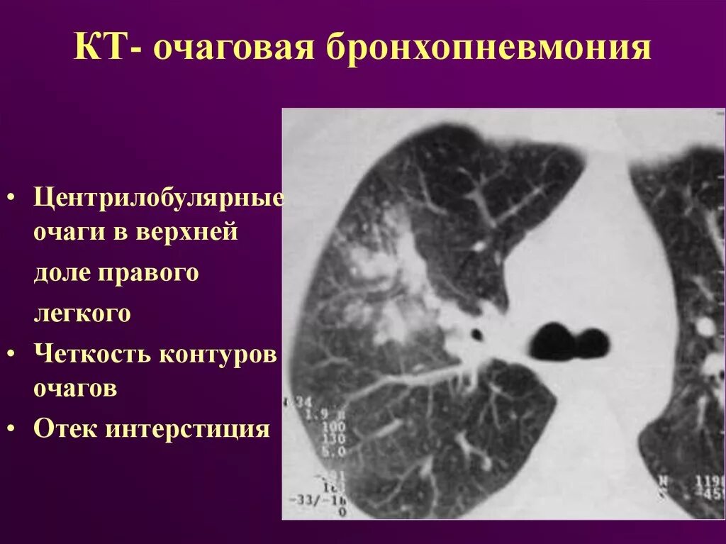 Бронхопневмония и бронхиолит на кт. Очаговая бронхопневмония кт. Крупозная пневмония и бронхопневмония. Полисегментарная бронхопневмония кт.