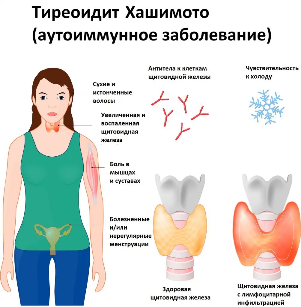 Какие симптомы заболевания щитовидной. Аутоиммунное поражение заболевание щитовидной железы-. Аутоиммунный тиреоидит щитовидной железы что это такое. Хронический аутоиммунный тиреоидит симптомы. Болезнь Хашимото (аутоиммунный тиреоидит).