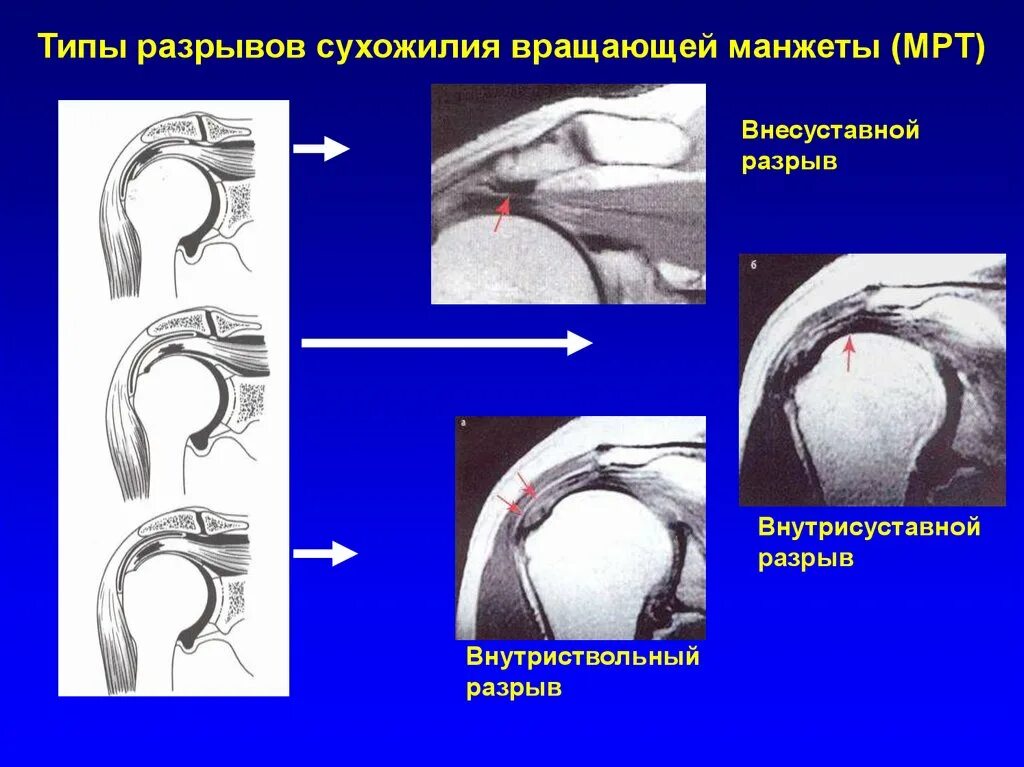 Разрыв сухожилия плечевого сустава на мрт. Ротаторная манжета мрт. Ротаторная манжета плечевого сустава разрыв. Разрыв вращательной манжеты плечевого сустава мрт.