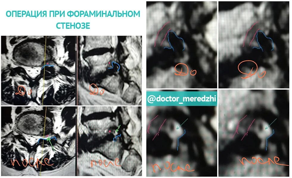Поясничный абсолютный стеноз. Фораминальный стеноз шейного отдела позвоночника. Фораминальный стеноз мрт. Операция при стенозе позвоночного канала. Фораминальный стеноз позвоночника.