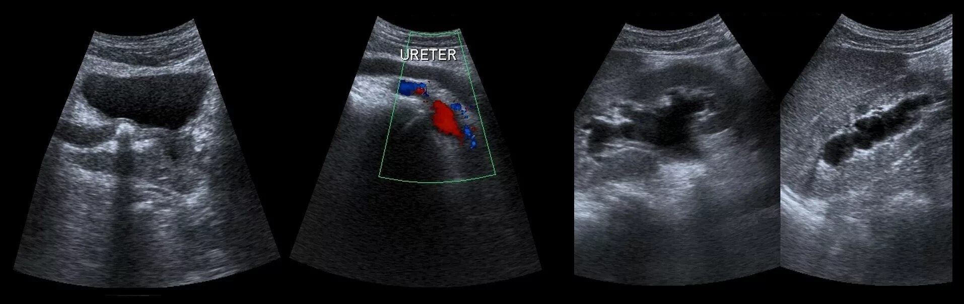 Камень верхней трети мочеточника УЗИ. Расширение мочеточника почки УЗИ. Коралловидный камень в почке УЗИ. На узи видно воспаление