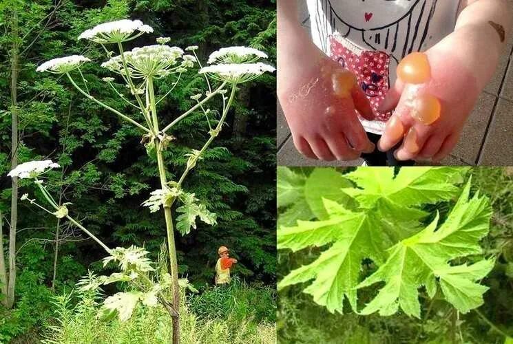 ожоги борщевик растение борщевик. ядовитое растение ожог. борщевик сосновского ожоги. борщевик сосновского ожог растение. ядовитое растение ожог.