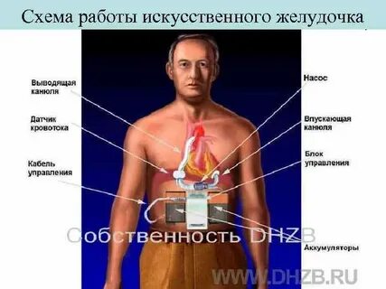 Сколько весит искусственный левый желудочек для сердца