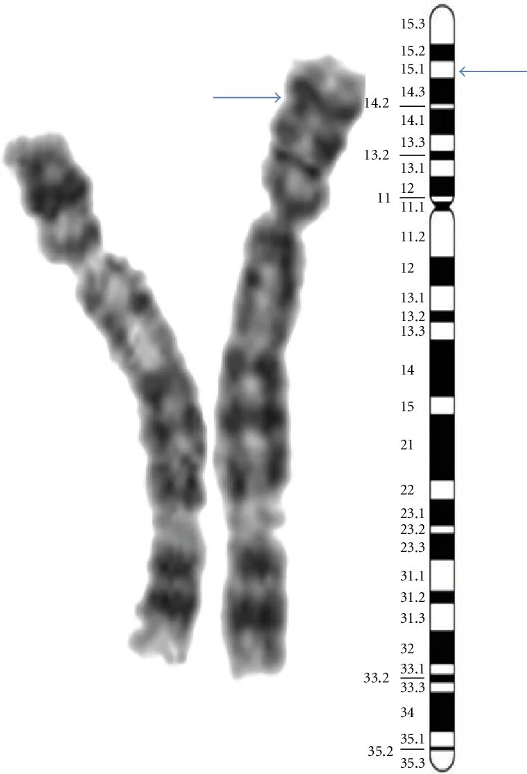 Делеция короткого плеча 5 хромосомы. 2p21 хромосома. Мужская хромосома 5
