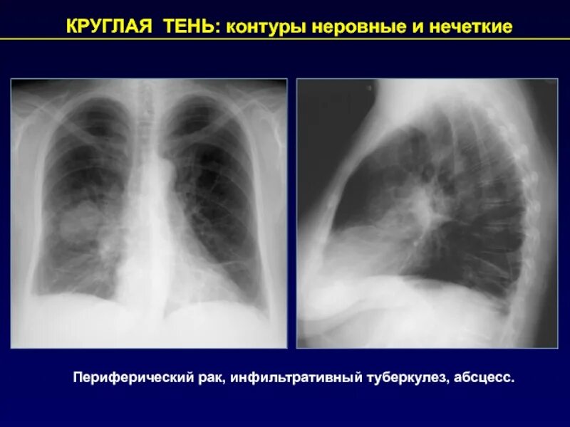 Округлое затемнение. Округлая тень с четкими контурами в легких. Округлая тень в легком. Округлые тени в легких. Бугристый контур легких.