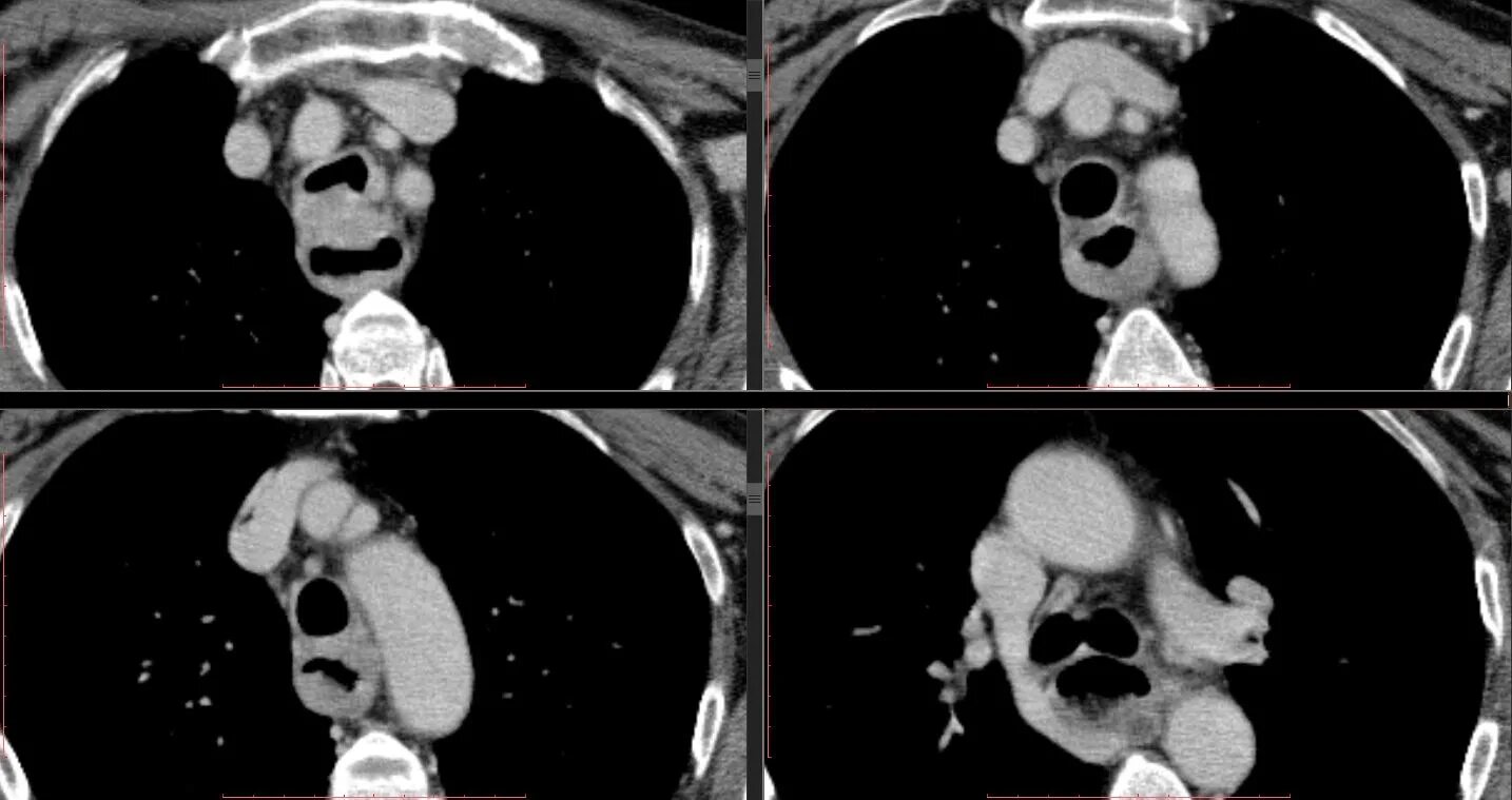 Кт пищевода и желудка. Ценкеровский дивертикул на кт. Дивертикул пищевода кт мрт. Дивертикул верхней трети пищевода на кт.