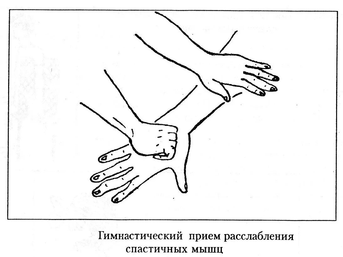 Тонус мышц при инсульте