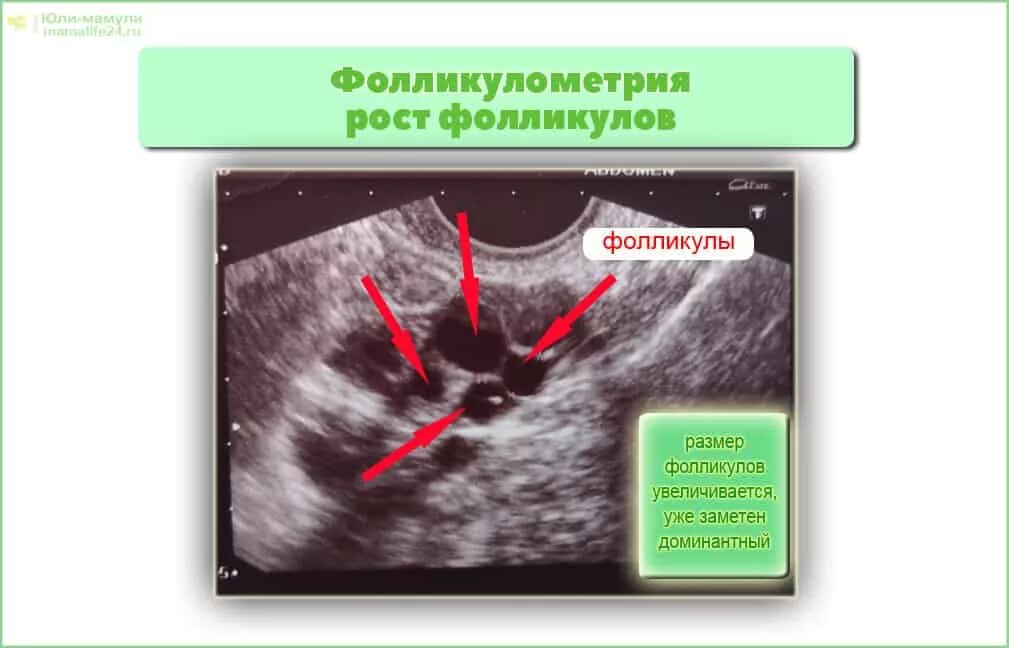 Максимальный размер фолликула. Узи фолликулометрия. рост фолликула. folekulometriya razmer.