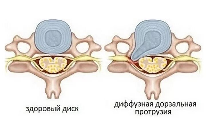 Диффузное выбухание межпозвоночного