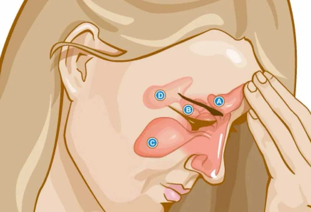 Инфекция носовых пазух.