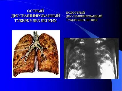 Острый очаговый туберкулез