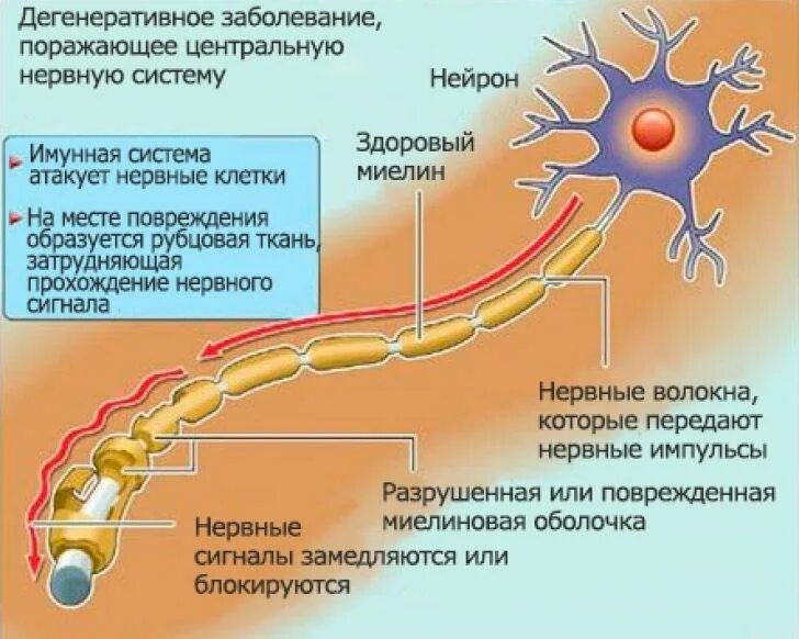 Разрушенная нервная система. Рассеянный склероз миелиновая оболочка. Миелин рассеянный склероз. Повреждение миелиновой оболочки болезнь. Рассеянный склероз поражает миелиновую оболочку.