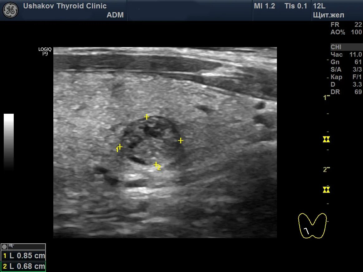 Узел в правой доле щитовидной железы. Анэхогенный узел щитовидной железы. Узлы щитовидной железы на УЗИ. УЗИ щитовидной железы узел левой доли.