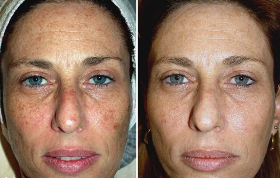 Как восстанавливается кожа. Пигментация на лице до и после. Фототерапия от пигментации. Лазерная шлифовка веснушек.