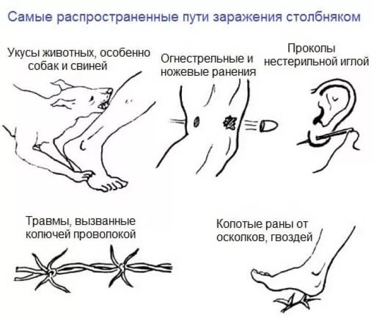 Сколько нельзя мыться после прививки от столбняка. Столбняк способы заражения симптомы. Патогномоничные симптомы столбняка. Столбняк механизм и путь передачи. Столбняк симптомы инкубационный период у человека.