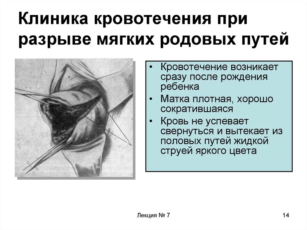 Разрывы мягких тканей родовых путей. Ушивание разрывов мягких родовых путей. Разрыв матки при родах. Разрыв шейки матки кровотечение.