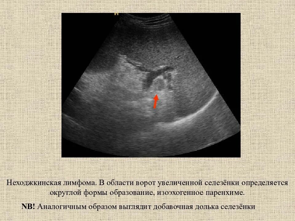 лимфоузлы печени селезенки. лимфатические сосуды селезенки. лимфоузлы печени селезенки. лимфоузлы печени селезенки. лимфома неходжкинская узи лимфоузлов.