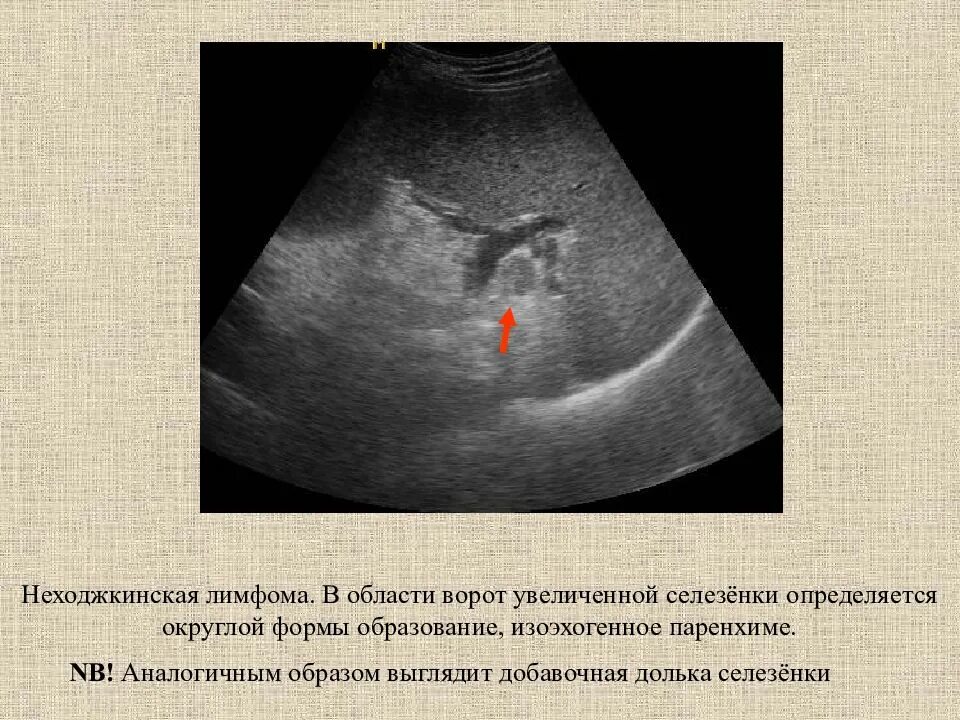 Лимфоузлы ворот печени на УЗИ. Добавочная долька селезенки на УЗИ. Лимфоузлы в воротах селезенки. Увеличенные лимфоузлы в печени