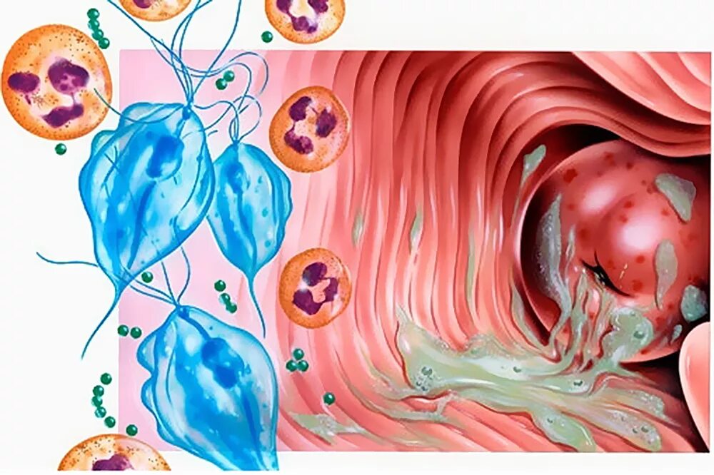 Трихомонадный кольпит. Трихомонада трихомонадный вагинит. Трихомонадный вагинит, уретрит. Протозойные (трихомониаз). Уретра у мужчин инфекция
