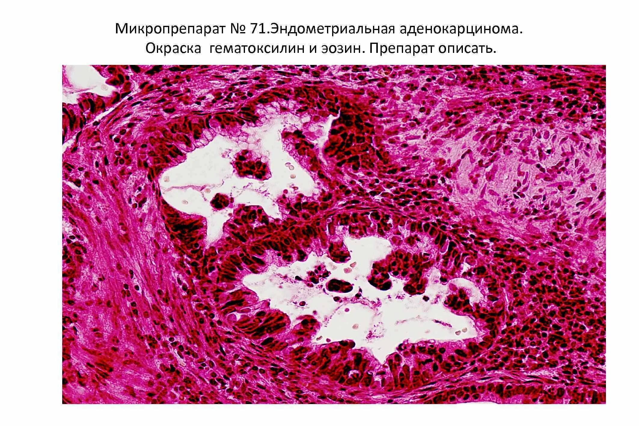 Стационарный эндоцервикоз шейки. Эндоцервикоз микропрепарат. Цервицит шейки матки гистология. Эпидермизирующий эндоцервикоз. Этапы правового образования.