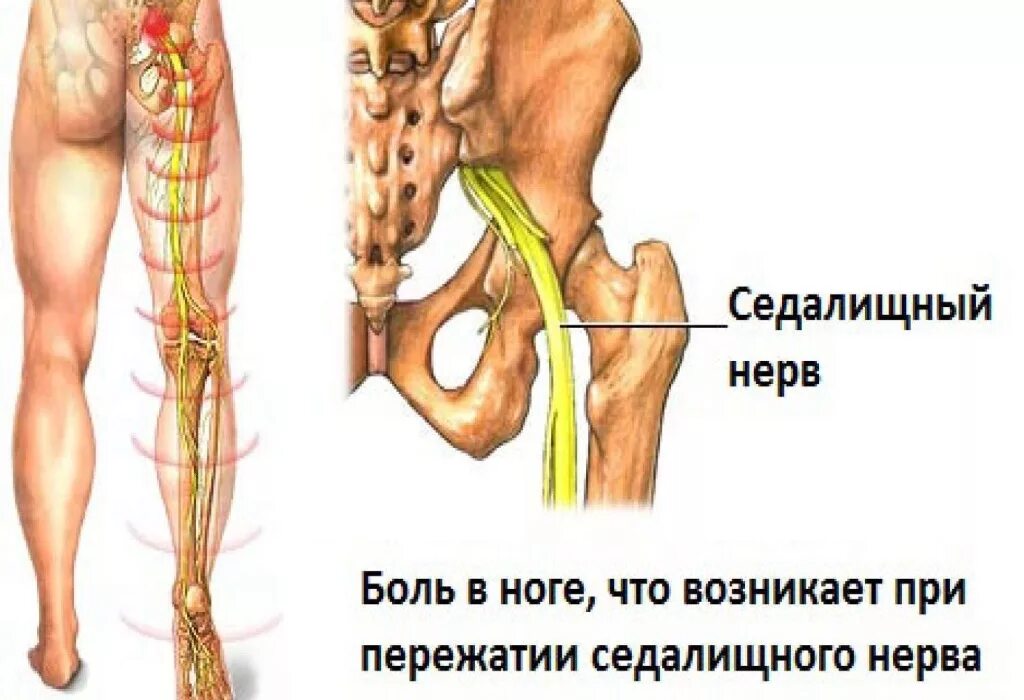 Боль в седалищном нерве симптомы
