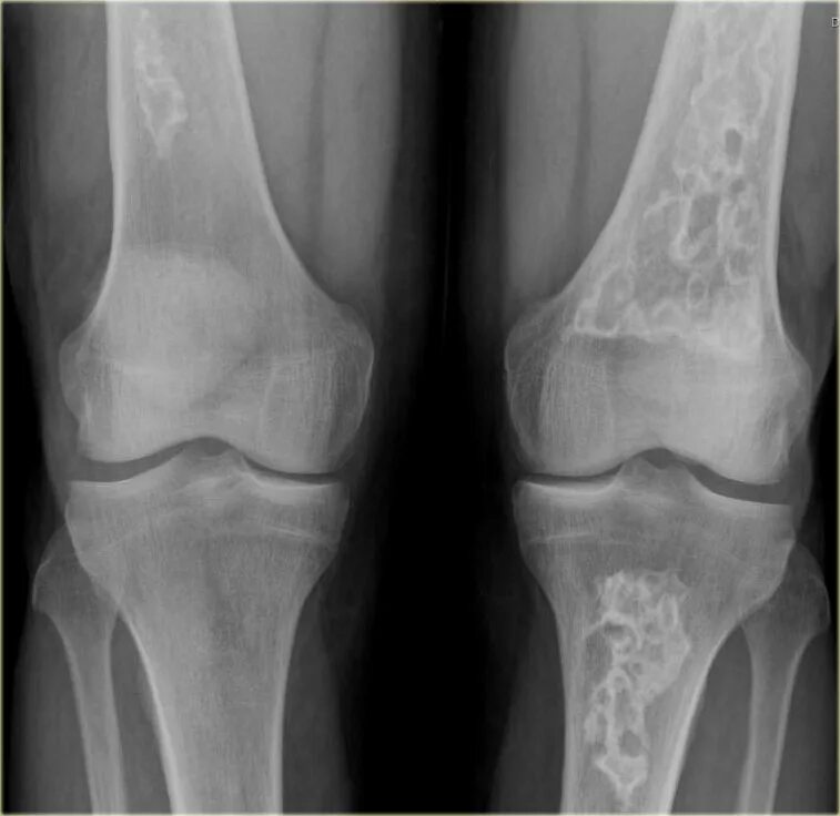 Энхондрома бедренной кости. Энхондрома диафиза бедренной кости. Асептический некроз коленного сустава рентген. Энхондрома головки бедренной кости. Некроз мыщелка бедренной