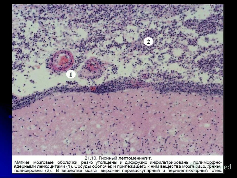 Перицеллюлярный отек головного мозга микропрепарат. Гнойный менингит микропрепарат. Туберкулезный менингит гистология. Туберкулезный менингит микропрепарат.