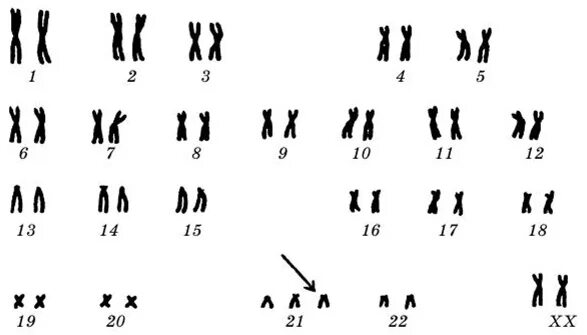 Кариотип при синдроме Дауна. Кариотип человека при синдроме Дауна. Болезнь Дауна кариотип. Трисомия 21 хромосомы (синдром Дауна кариотип. Лишняя 21 хромосома