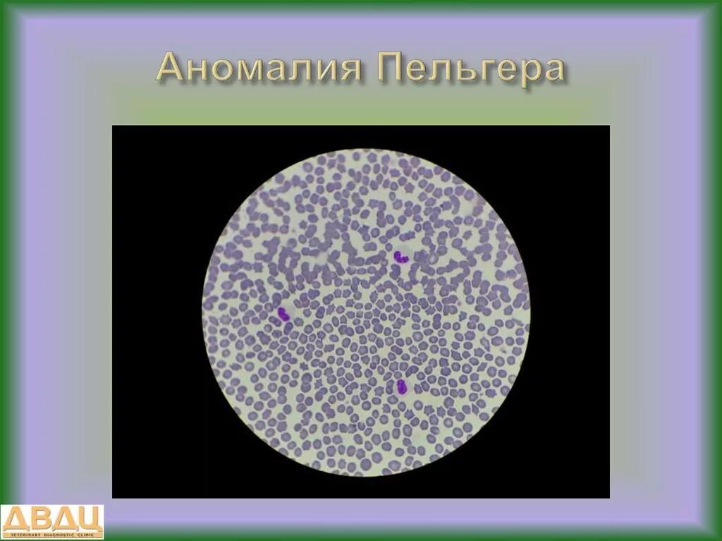 Аномалия 3 класса. Аномалия лейкоцитов пельгера. псевдопельгеризация ядер нейтрофилов. аномалия пельгера-хюэта.