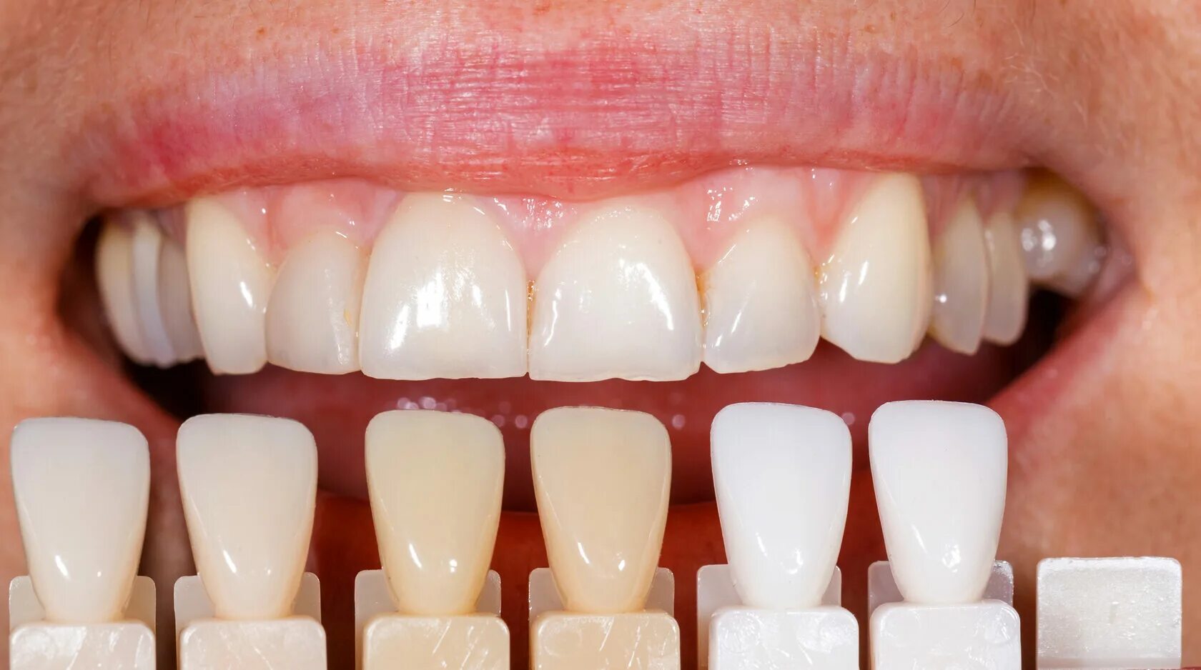 Палитра стоматология. Композитные виниры цвет а1.