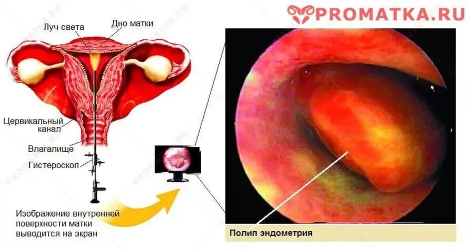 Гиперпластические процессы эндометрия гистероскопия. Пóлип в полости матки аденоматозный. Полип эндометрия в матке. Можно забеременеть с полипом в матке