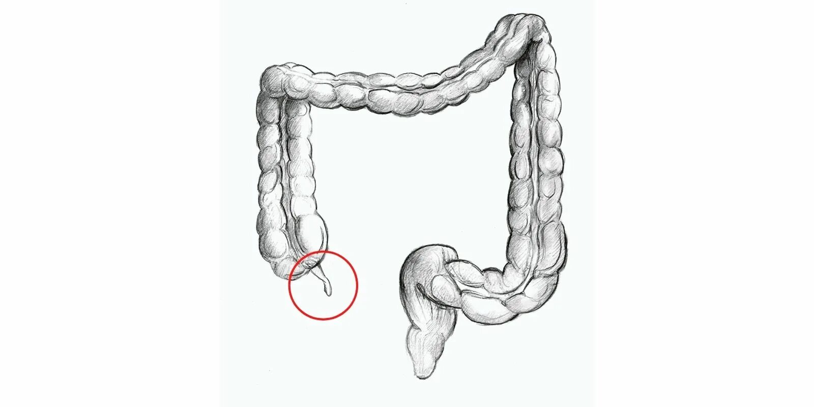 Аппендикс толстой кишки