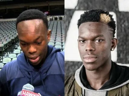 Dennis Schroder's Hairline Had A Better Comeback Than LeBron Coming Back From 3-