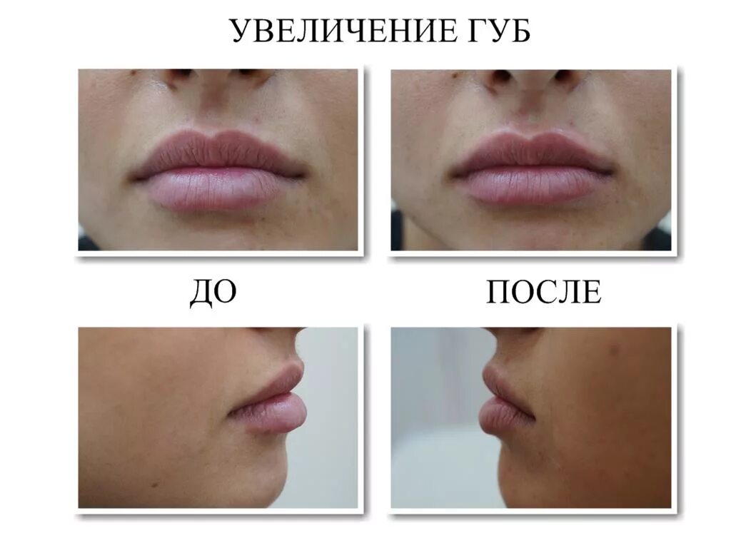 Увеличение губ до и после отзывы. Увеличение губ до и после. Губы гиалуроновой кислотой. Увеличение губ гиалуроновой кислотой.