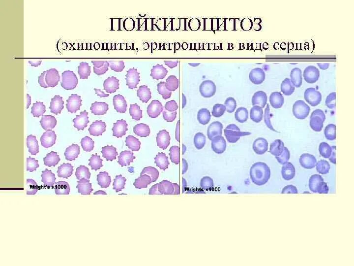 Пойкилоцитоз формы эритроцитов. Анизо и пойкилоцитоз. Стоматоциты пойкилоцитоз. Формы эритроцитов эхиноциты. Эхиноциты