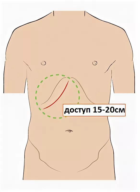 операция лапароскопическая холецистэктомия. лапароскопия почки шрамы. удаление желчного пузыря разрезом. лапароскопическая хирургия желчный пузырь. операция минилапаротомия холецистэктомия.