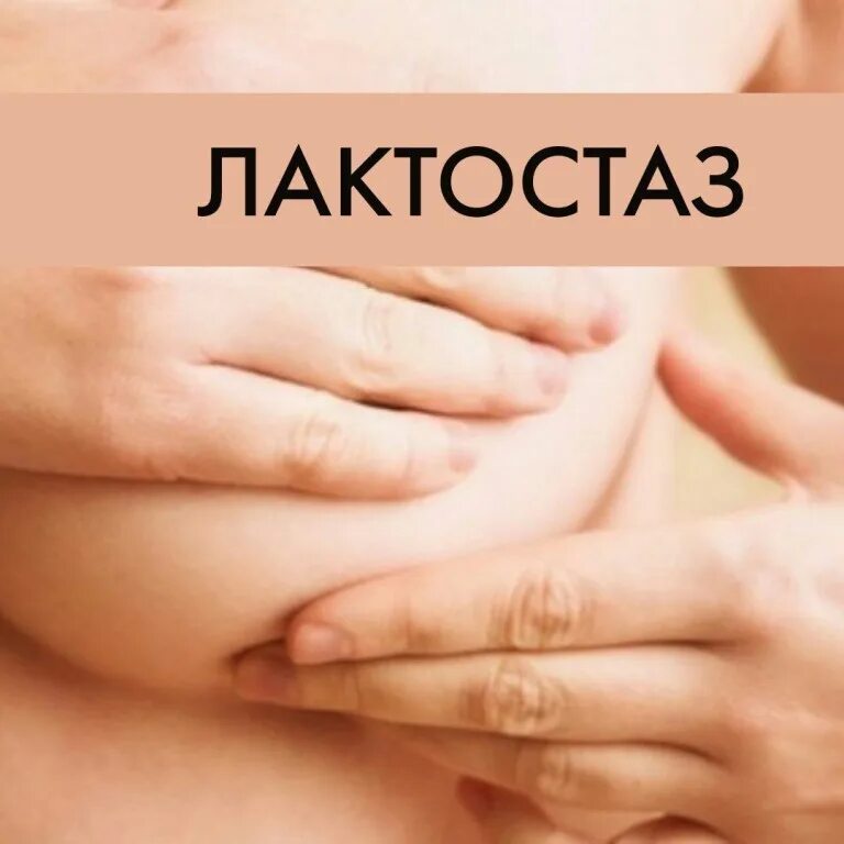 Лактостаз. Причины лактостаза. Лактостаз маммолог. Лактостаз как выглядит. Лактостазы у кормящей мамы