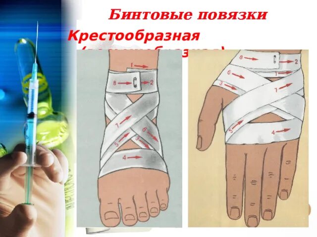 Техника наложения крестообразной повязки. Крестообразная повязка техника наложения. Восьмиобразная повязка на руку. Восьмиобразная повязка на кисть. Преимущества бинтовой повязки.