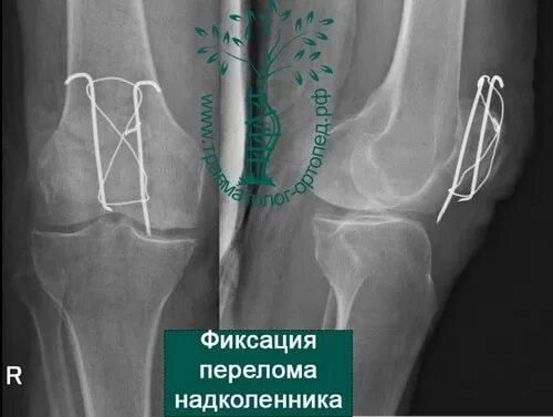 Перелом надколенника снимок. Застарелый перелом надколенника. Перелом надколенника рентген. Надколенник коленного сустава рентген оскольчатый перелом. Перелом надколенника операции