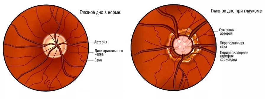 Норма зрительного нерва. Диск зрительного нерва анатомия. ДЗН сосуды офтальмоскопия. Глазное дно при офтальмоскопии норма. Схема патологии глазного дна.