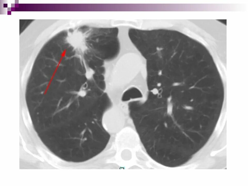 Периферическая карцинома легких кт. Бронхоальвеолярная карцинома на кт.