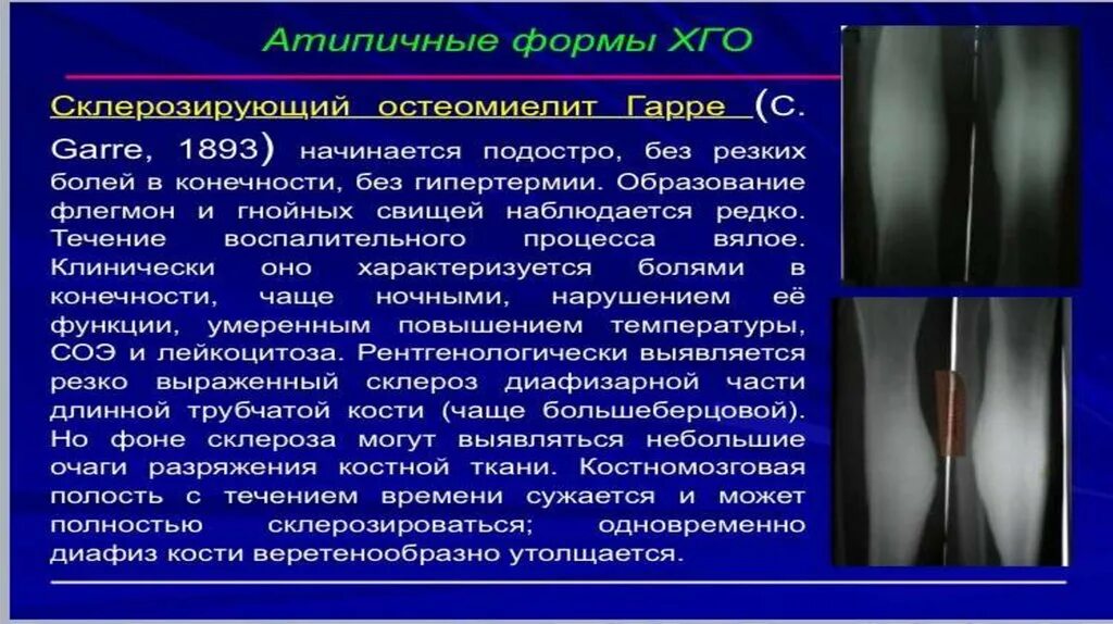 Склерозированный остеомиелит. Хронический остеомиелит большеберцовой кости кт. Альбуминозный остеомиелит оллье рентгенография. Остеомиелит бедра рентген. Остеомиелит гарре большеберцовой кости.