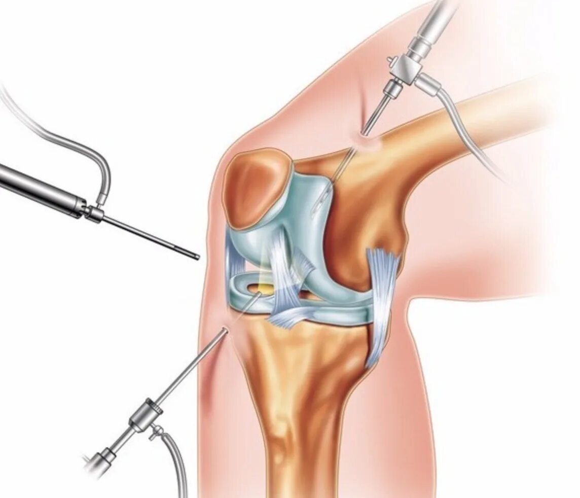 Артроскопия дебридмент. Артроскопия ПКС коленного сустава. Ревматоидный артрит артроскопия. Артроскопия деформирующий остеоартроз.