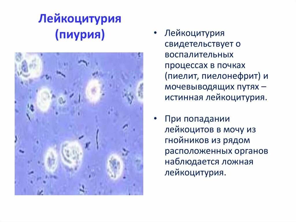 Лейкоциты в моче лейкоцитурия. Лейкоцитурия механизм развития. Ложная лейкоцитурия. Пиелонефрит лейкоцитурия. Пиурия классификация.