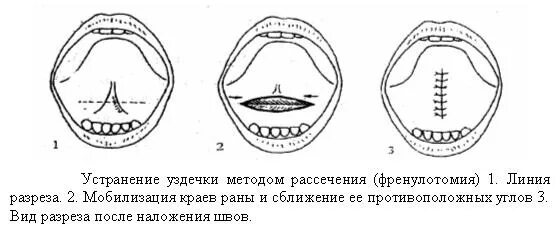 Уздечка языка - верхняя уздечка губы - Pavlos Tsolaridis, M.D. - Хирург - Оторин
