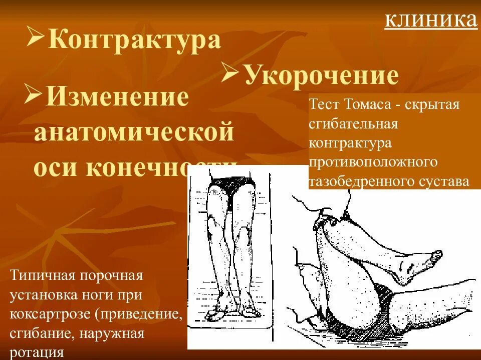 Стойкая контрактура сустава. Ладонный фиброматоз (контрактура дюпюитрена). Стойкая контрактура сустава. Контрактура голеностопного сустава. Стойкая контрактура сустава.