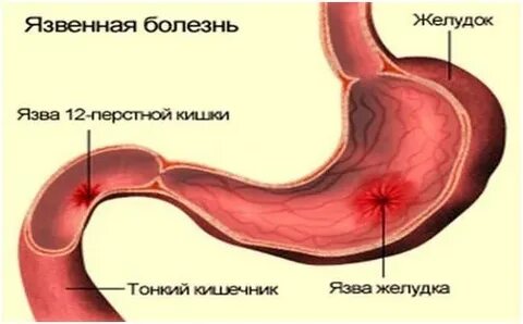 Больной язвенной болезнью